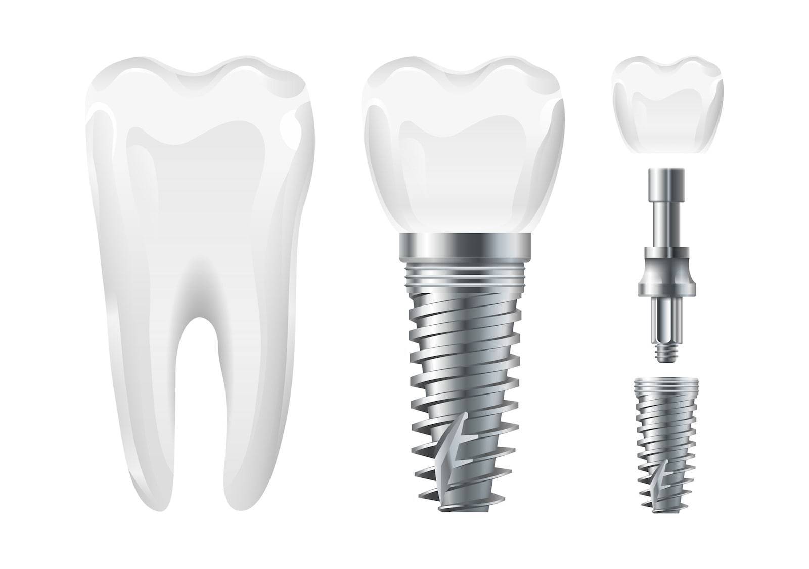 Dental surgery. Implant cut and healthy tooth. Realistic vector dental implant and crown.